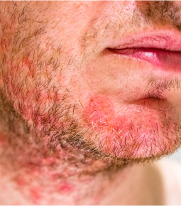 visage homme avec maladie de peau